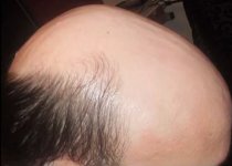 severe-baldness-7773.jpg