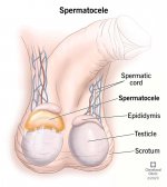 17492-spermatocele.jpg
